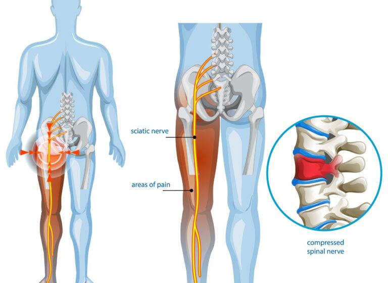 Sciatica Treatment