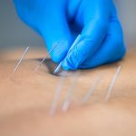 How Dry Needling Helps Relieve Chronic Pain and Restore Mobility