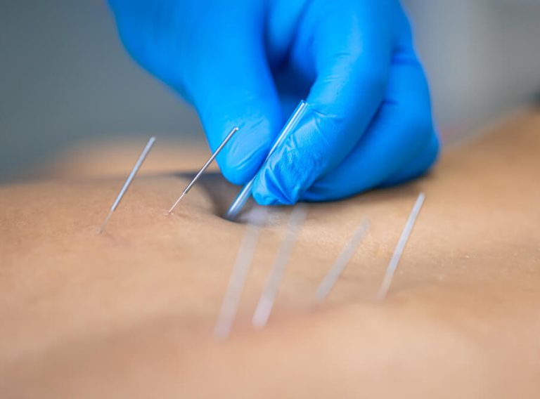 Dry Needling for Chronic Pain Relief