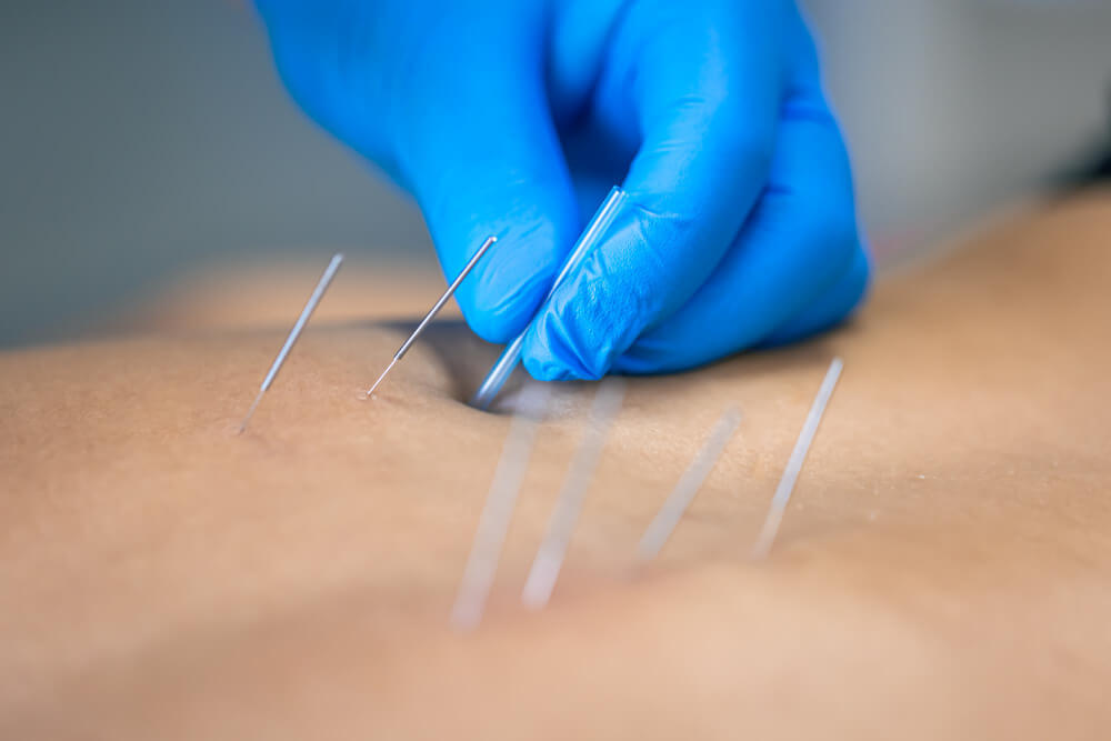 Dry Needling for Chronic Pain Relief