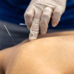 Dry Needling Kanata: Fast Relief for Muscle Pain & Tightness