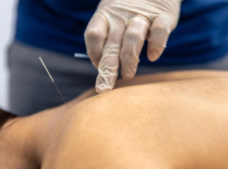 Dry Needling Kanata