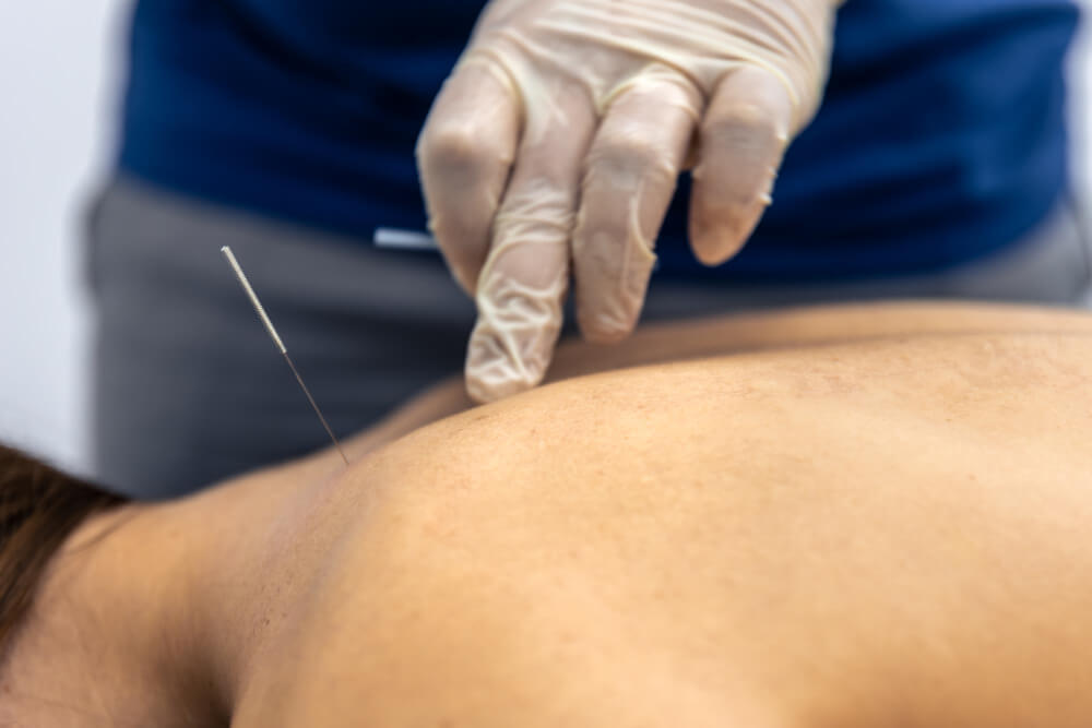 Dry Needling Kanata