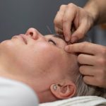 Facial Acupuncture Near Me: Natural Skin Rejuvenation in Kanata