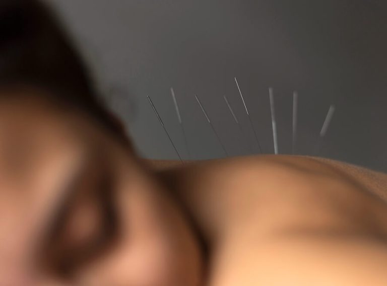 acupuncture